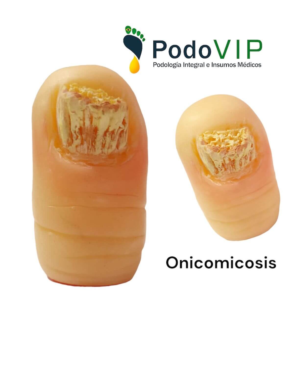 Onicomicosis