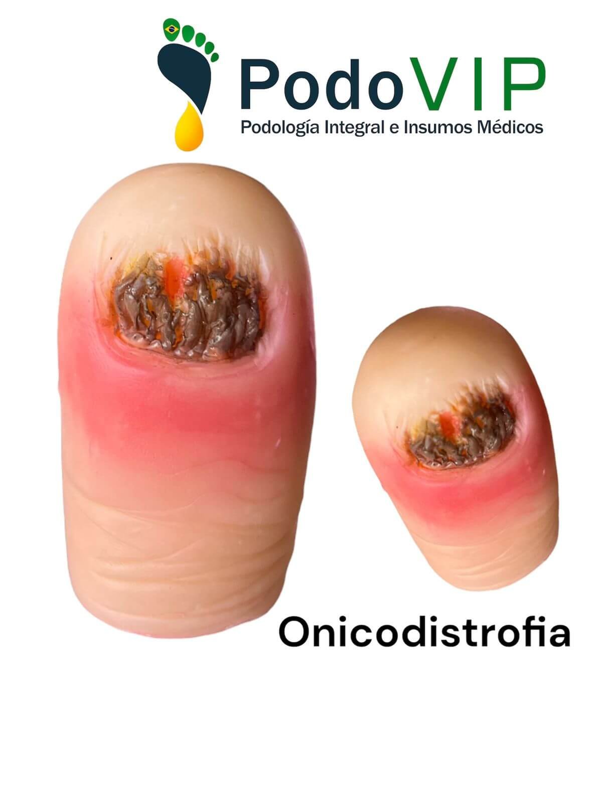 Onicodistrofia