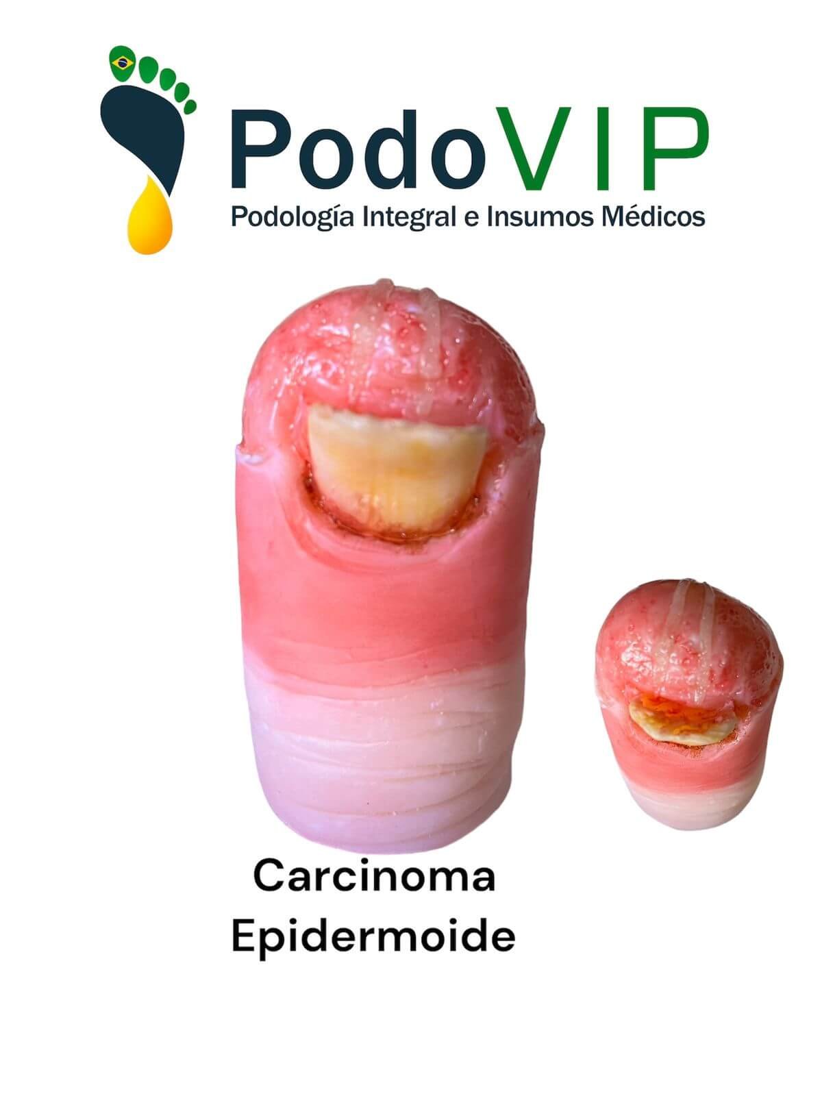 Carcinoma Epidermoide