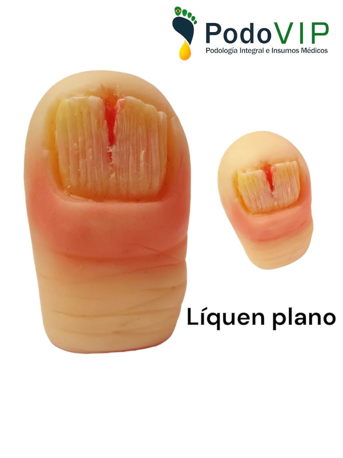 Líquen Plano