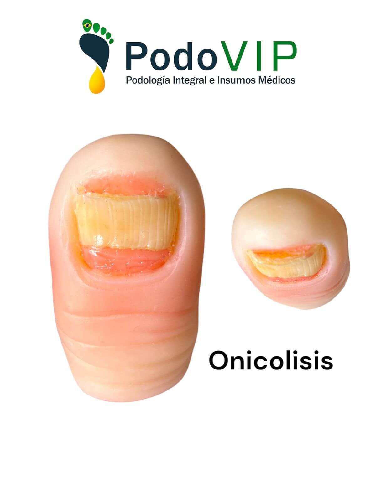 Onicolisis