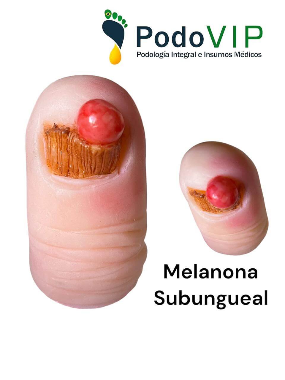 Melanona Subungueal