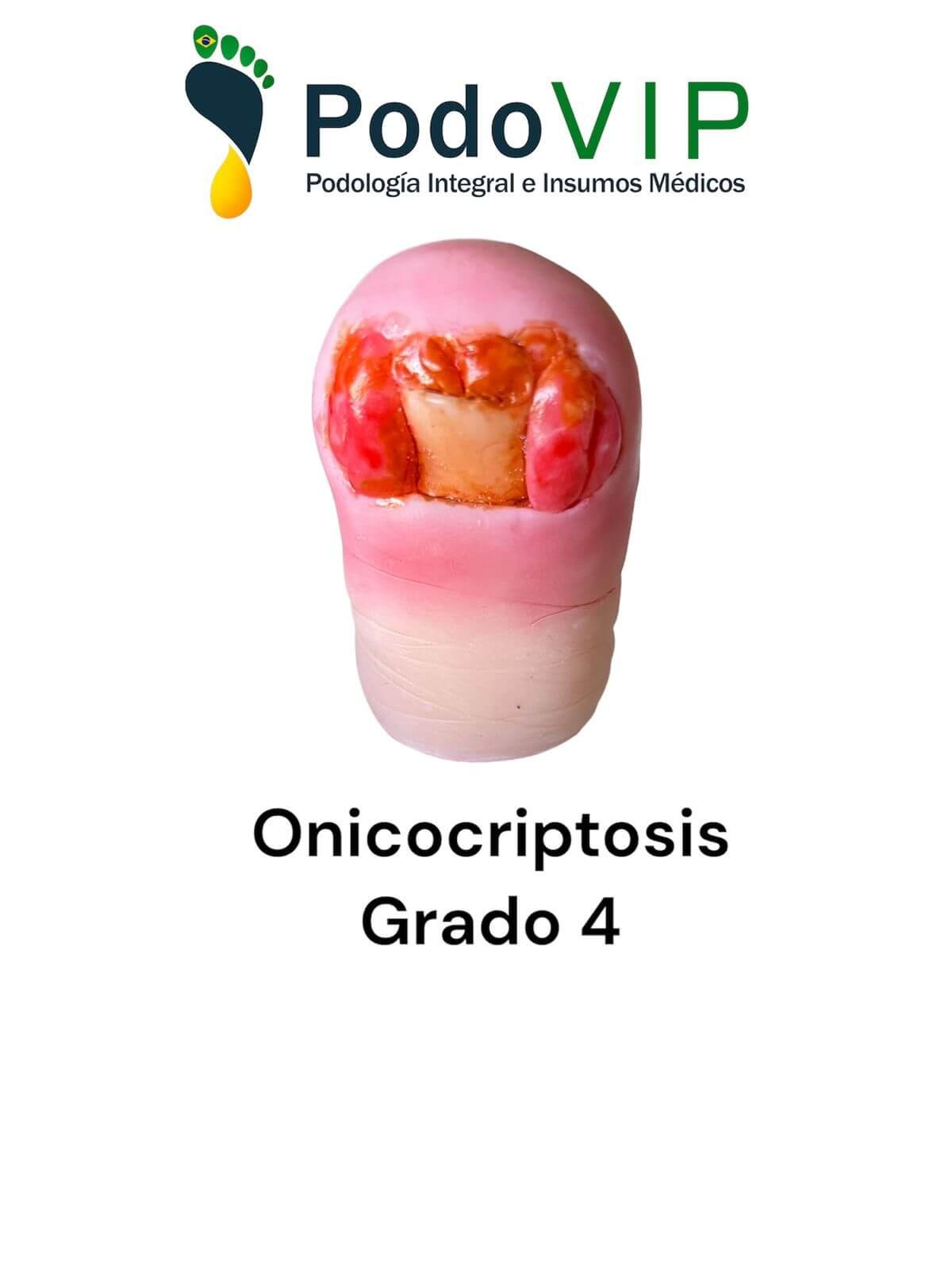 Onicocriptosis Grado 4