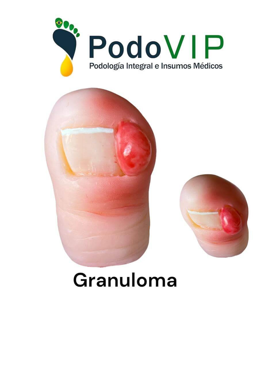 Granuloma