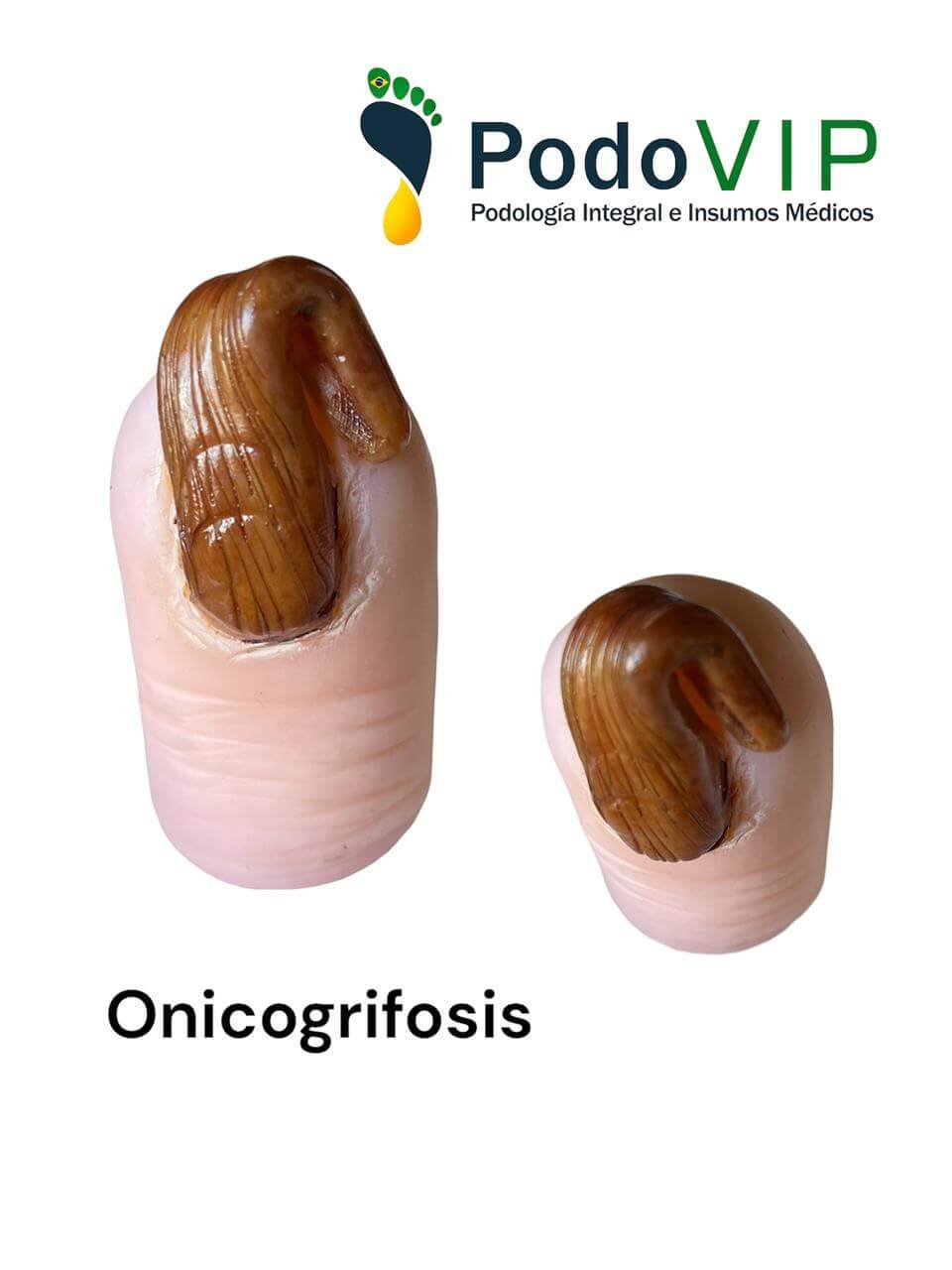 Onicogrifosis
