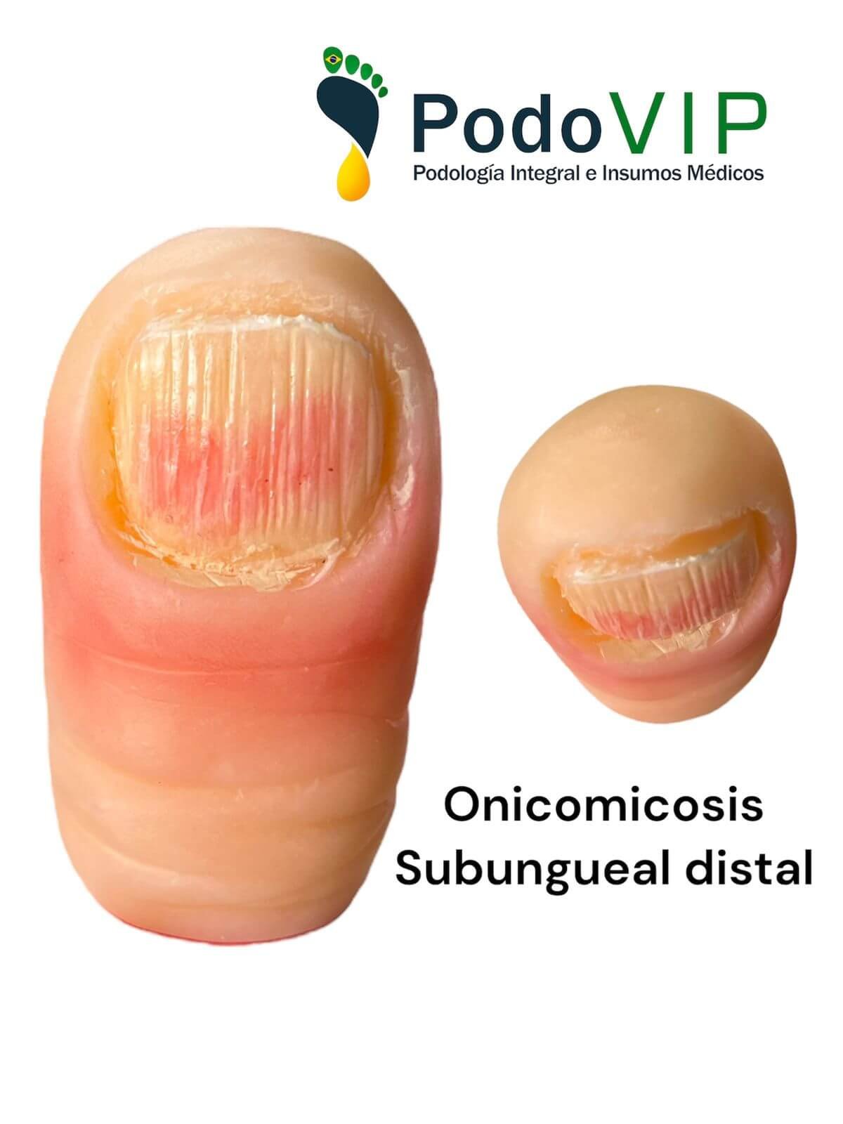 Onicomicosis Subungueal Distal