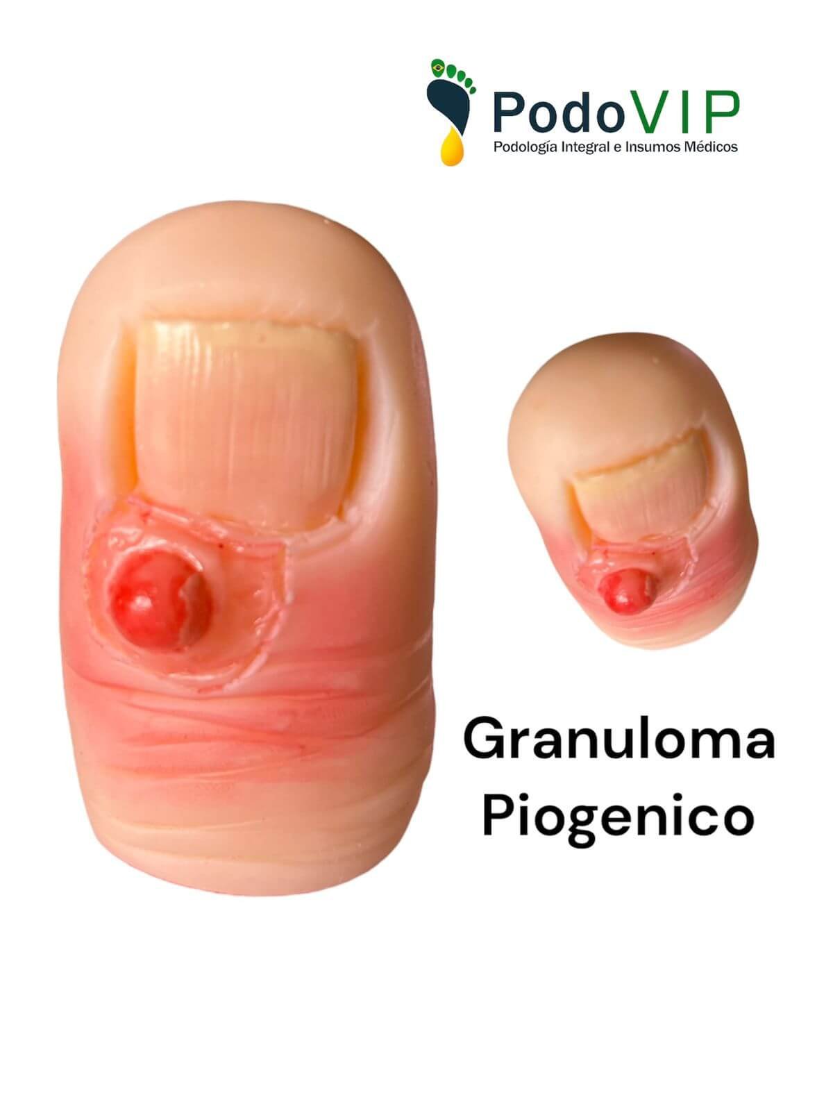 Granuloma Piogenico