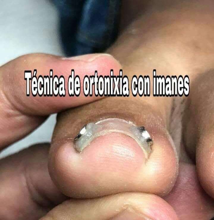 IMANES DE NEODIMIO- ORTINIXIA