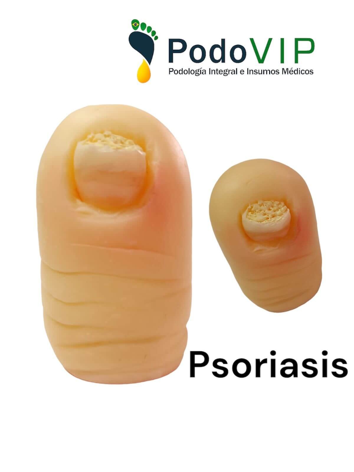 Psoriasis